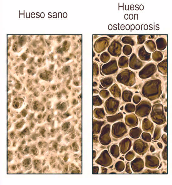 huesos con osteoporosis